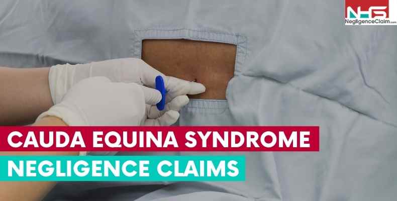 Cauda Equina Syndrome Negligence